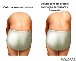 Coluna com escoliose e formação da Giba ou corcunda
