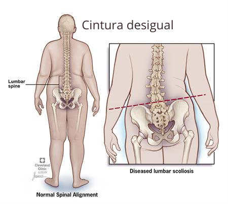 A escoliose causa a cintura desigual