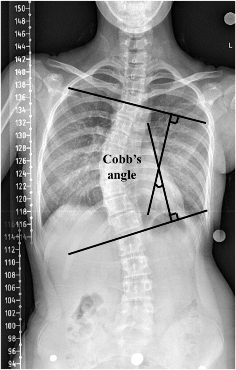 angulo de cobb para medir escoliose