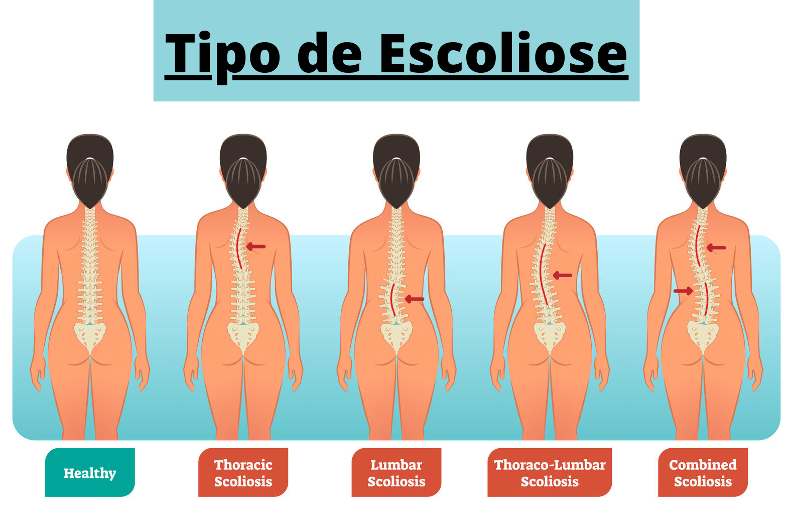 Qual a diferença entre escoliose e má postura?