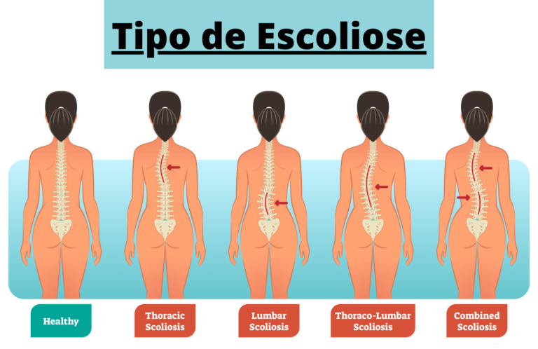 O Que É Escoliose E Como O Tratamento De Quiropraxia Pode Ajudar