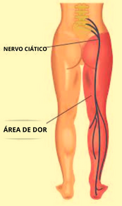O QUE É O NERVO CIÁTICO