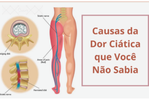 O Que Causa A Dor No Nervo Ciático