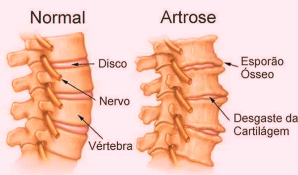 artrose na coluna vertebral